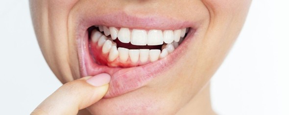 Mujer con gingivitis